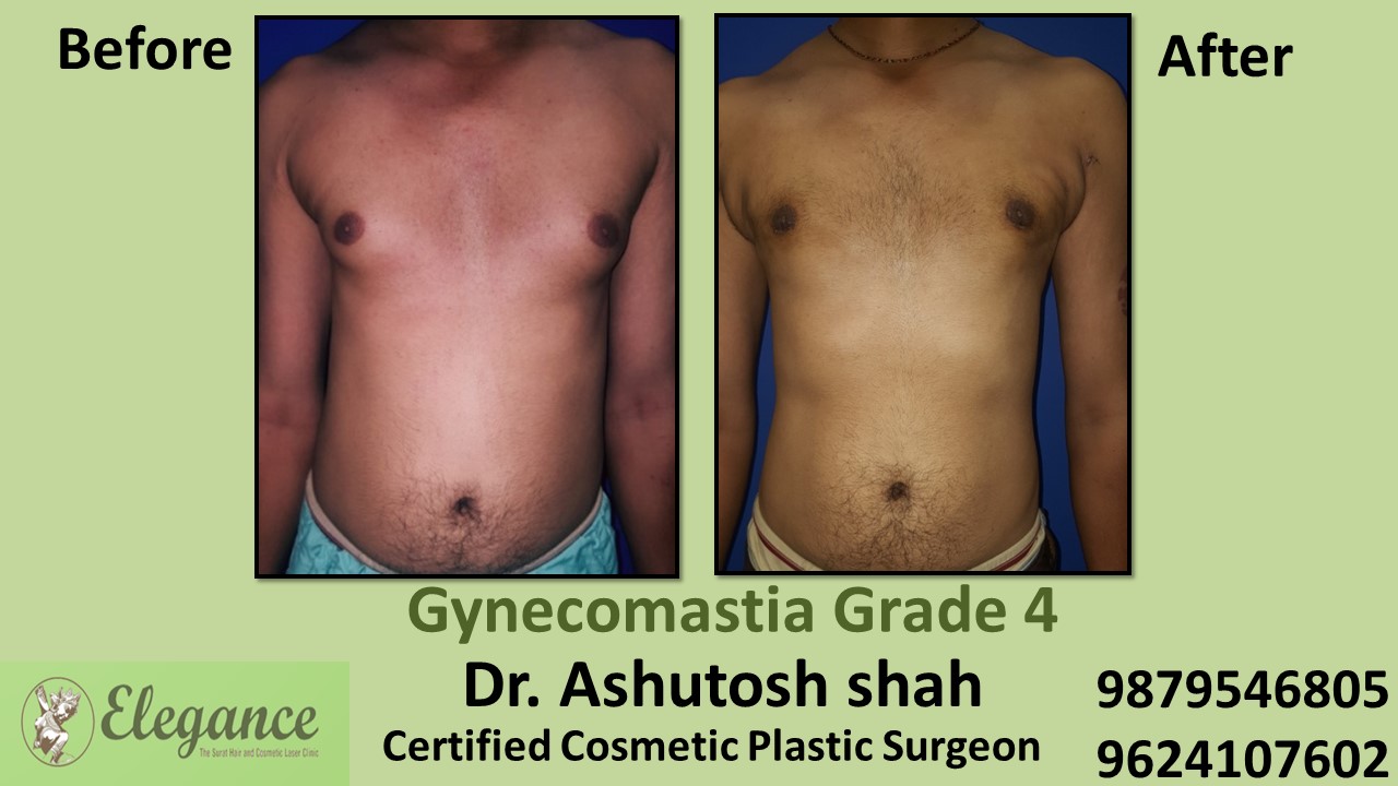 Male Large Breast Surgery Results in Chhota Udaipur, Gujarat