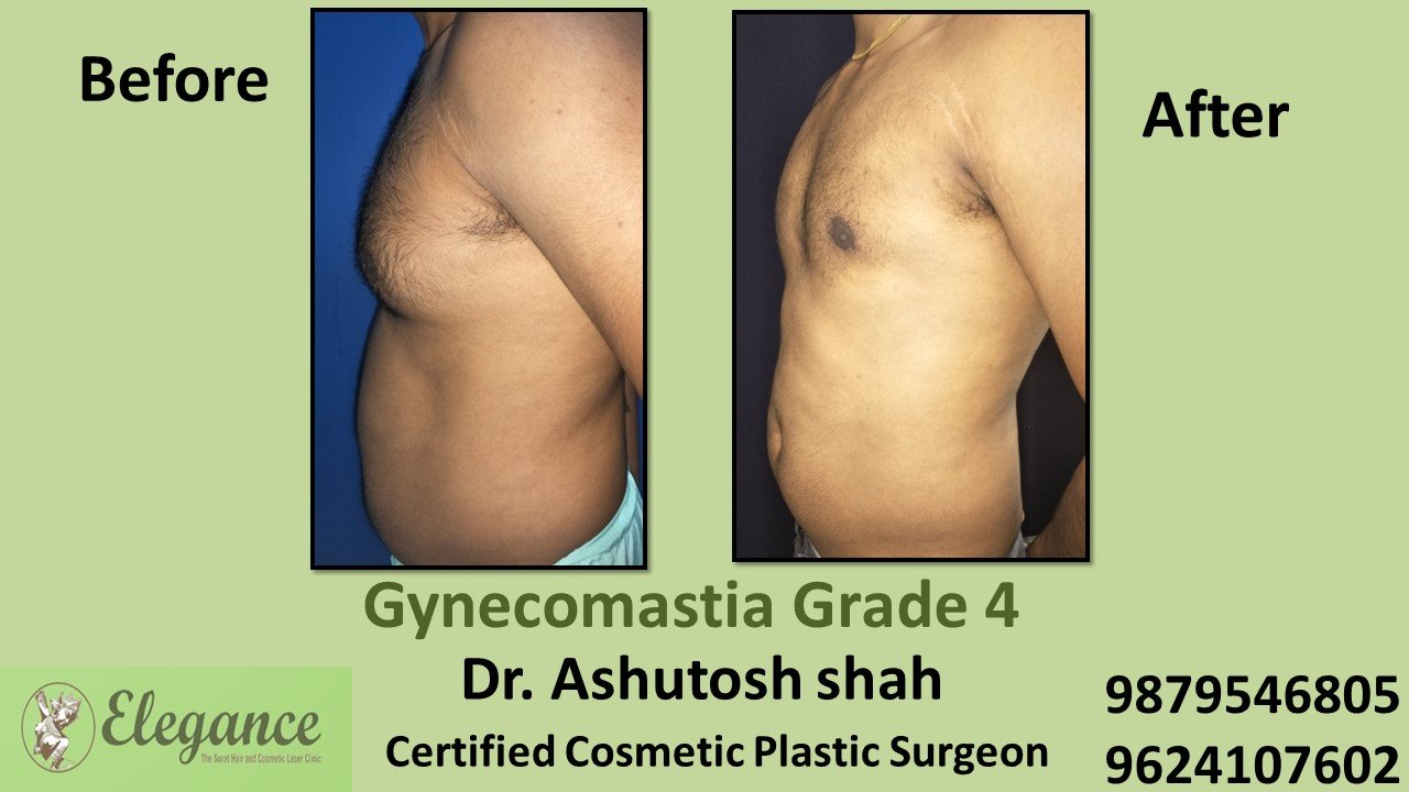 Male Large Breast Surgery Results in kosamba, Gujarat