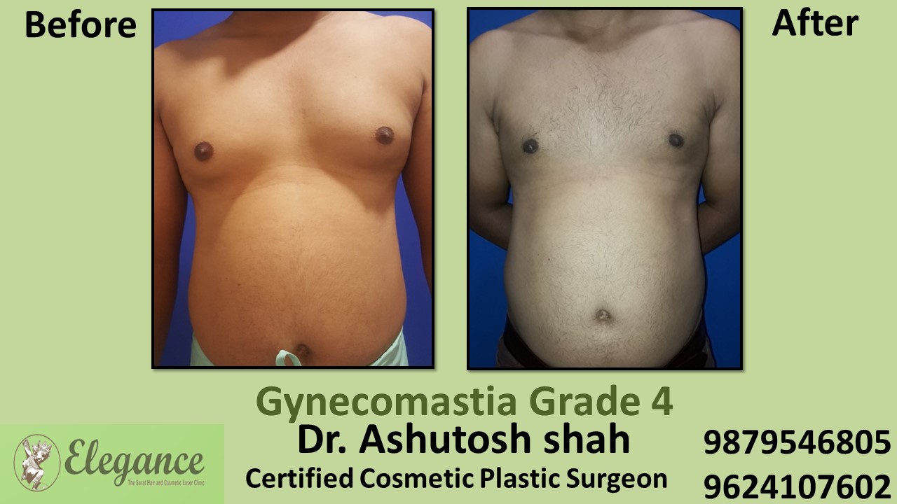 Male Large Breast Surgery Results in Mangrol, Gujarat