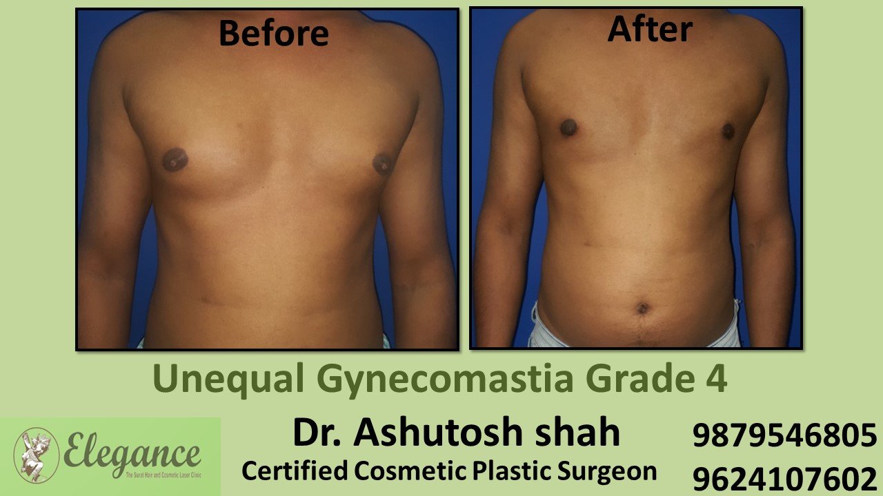 Male Large Breast Surgery Results in Surat, Gujarat