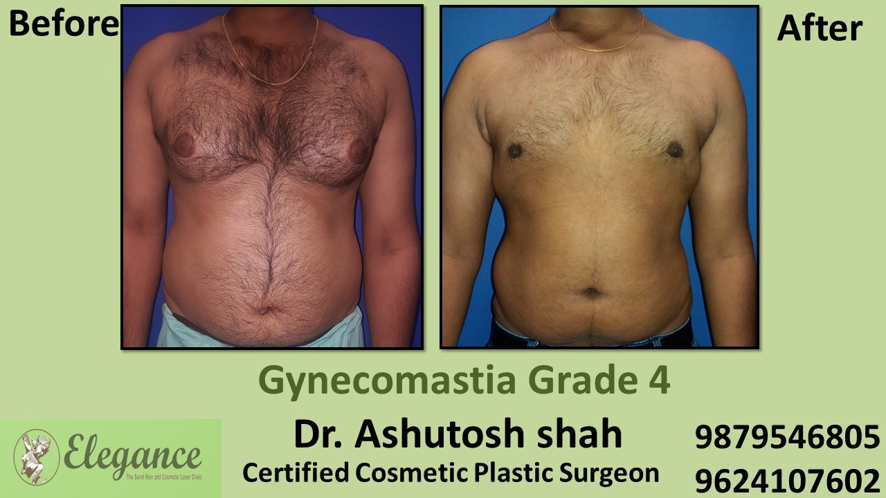 Type 4 Gynecomastia - Moderate Breast Roll