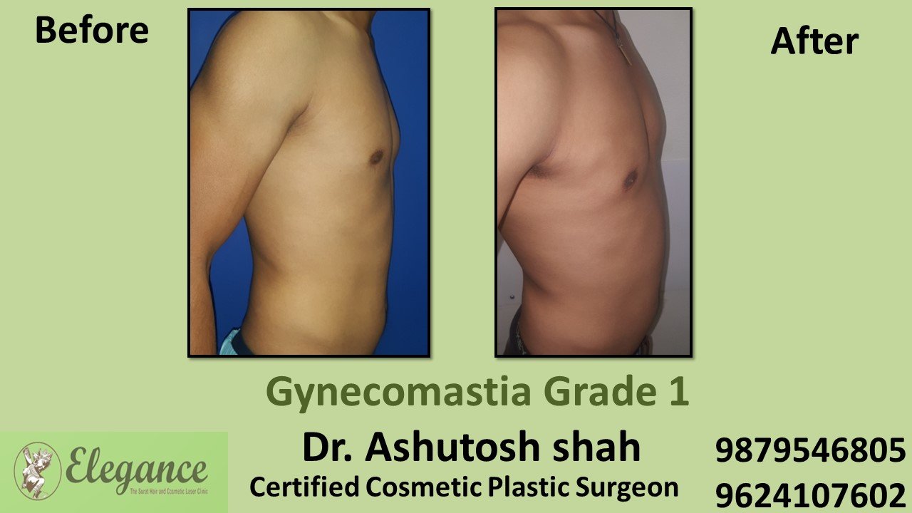 Men Large Breast Treatment- Grade 1 Gynecomastia, in Surat, Gujarat