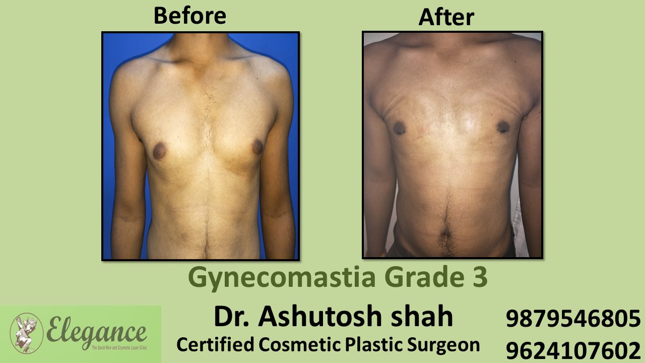 Men Large Breast Treatment- Grade 1 Gynecomastia, in Vadodara, Gujarat