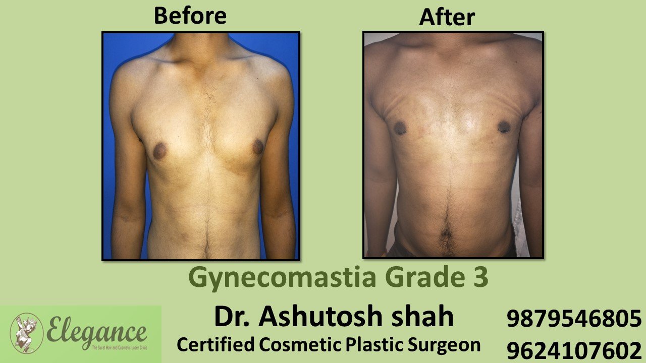 Men Large Breast Treatment- Grade 1 Gynecomastia, in Vadodara, Gujarat