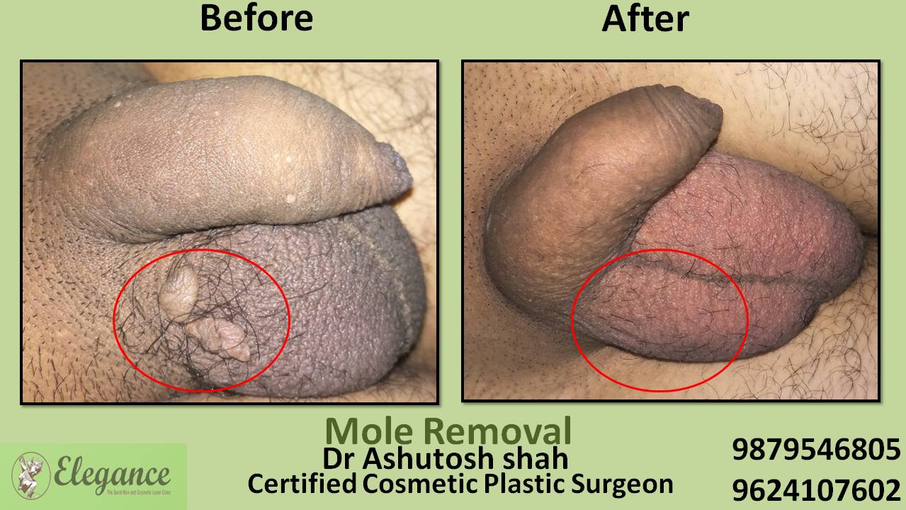Mole Removal From Male Private Part, Surat