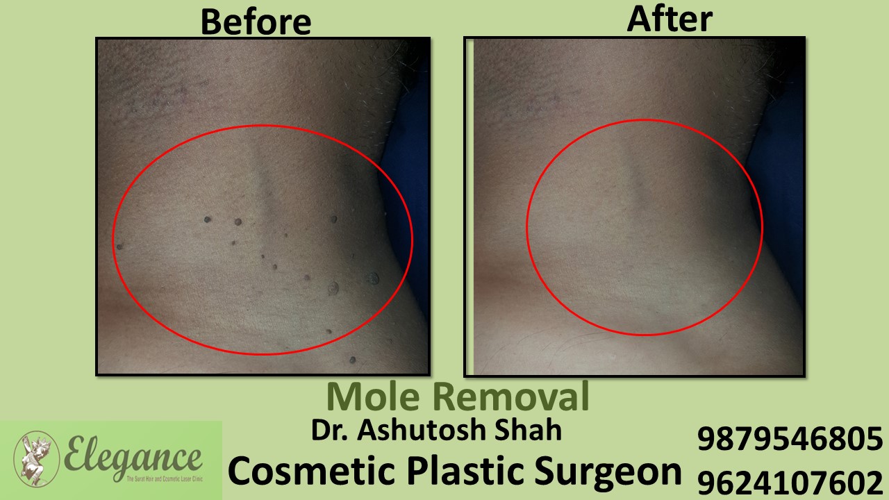 Mole Removal from Neck Experts in Surat, Gujarat