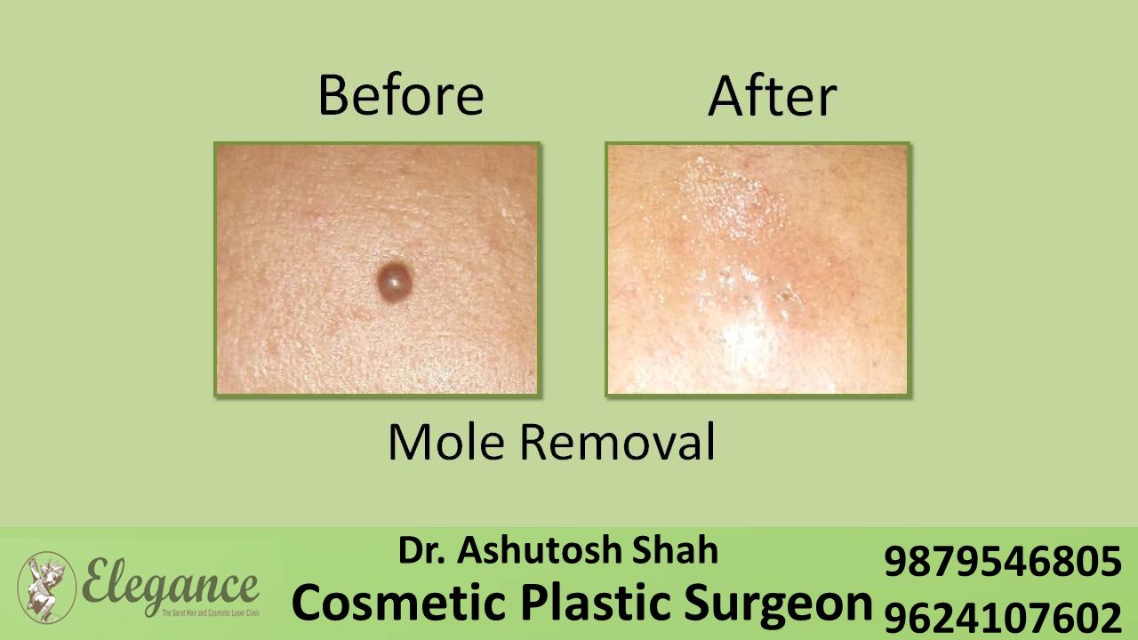 Mole Removal In Vadodara, Gujarat, India.