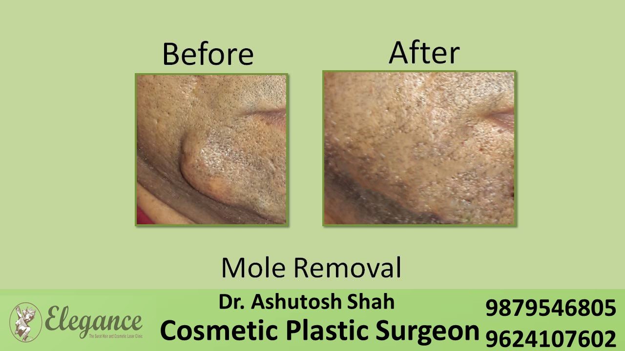 Mole Removal In Valsad, Gujarat, India.