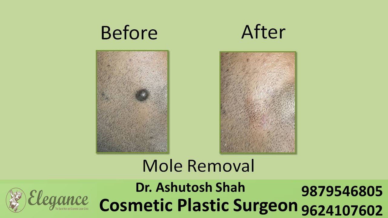 Mole Removal In Vapi, Gujarat, India.