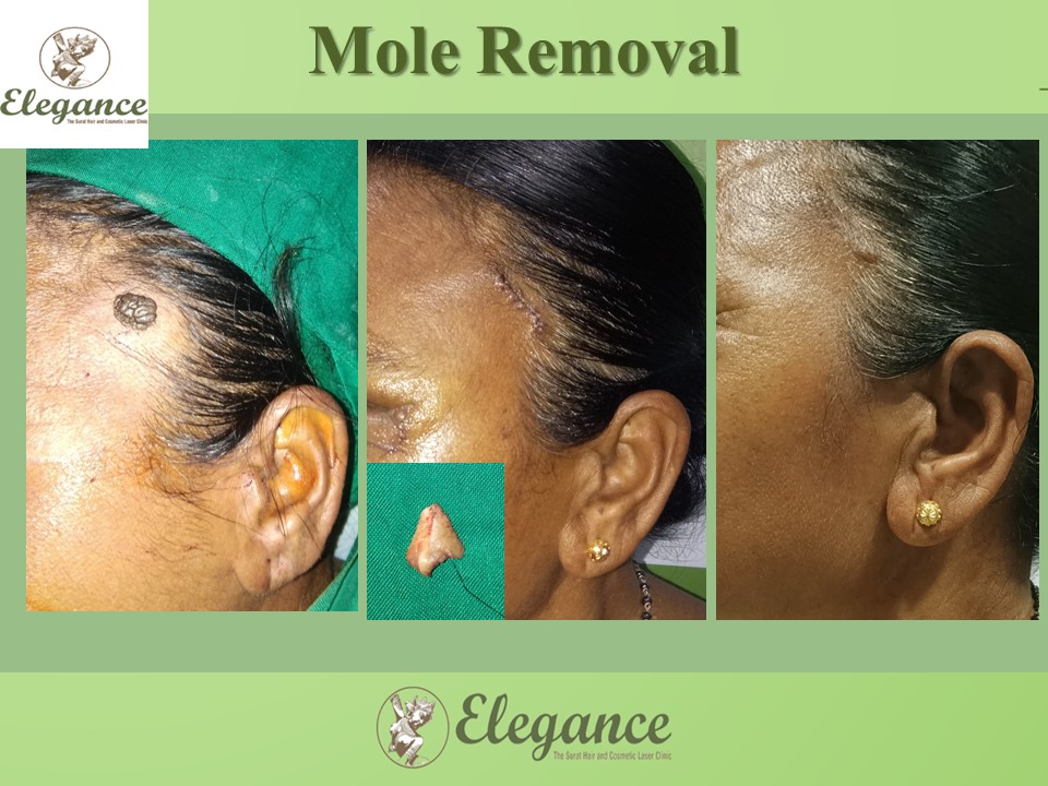 Mole Removal Treatment, Kamrej, Gujarat, India.