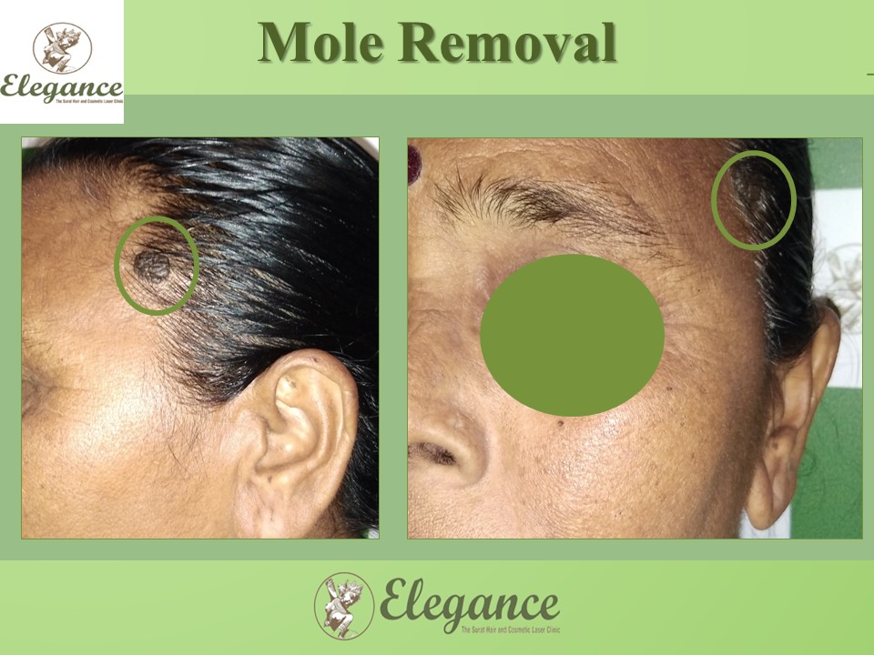 Mole Removal Treatment, Navsari, Gujarat, India.
