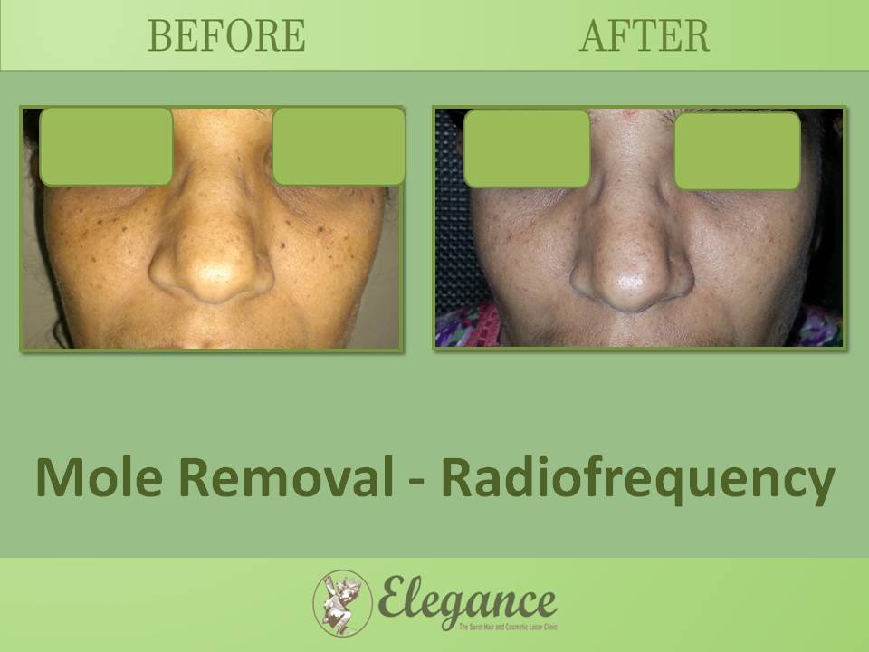 Mole Removal Treatment, Surat, Gujarat, India.