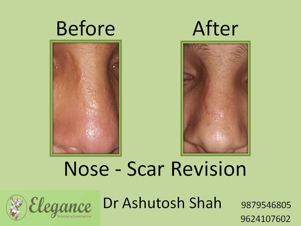 Nose Scar Revision Surgery, Bharuch, Gujarat, India.