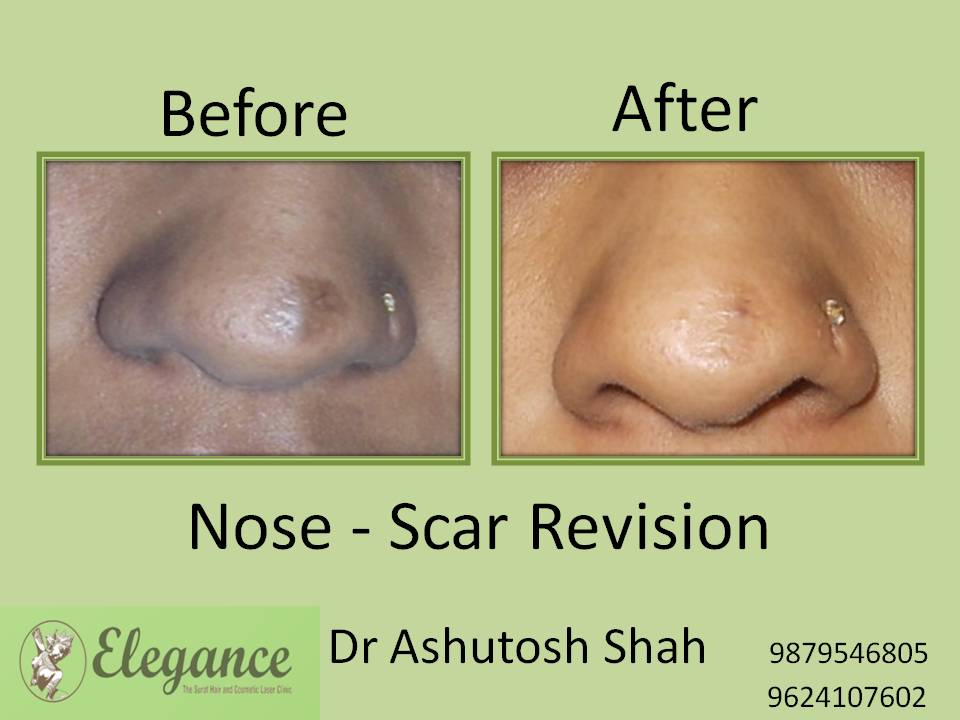 Nose Scar Revision Surgery, Surat, Gujarat, India.
