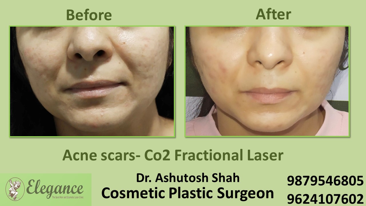 Peeling Acne Chemical Treatment Before And After Result In Vesu, Magdalla,  Amroli, Surat.