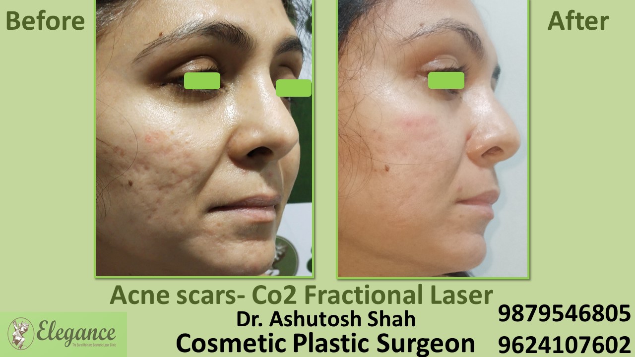 Peeling and Acne Scar Treatment In  Katargam, Vesu, Surat