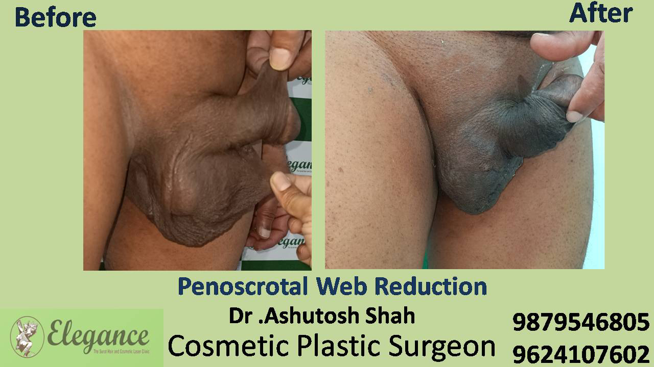 Penoscrotal Web Reduction Surgery in Surat, Gujarat (India)