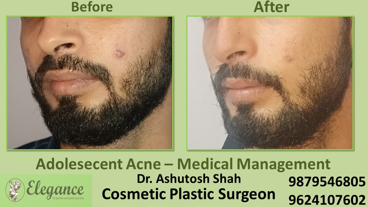 Permanent Acne Scar Removal Treatment In Surat, Bharuch, Valsad.