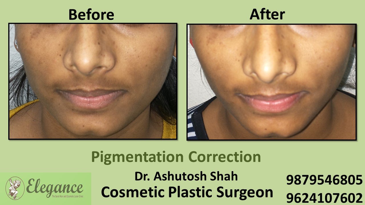 Pigmentation Treatment in Bharuch, Gujarat, India.