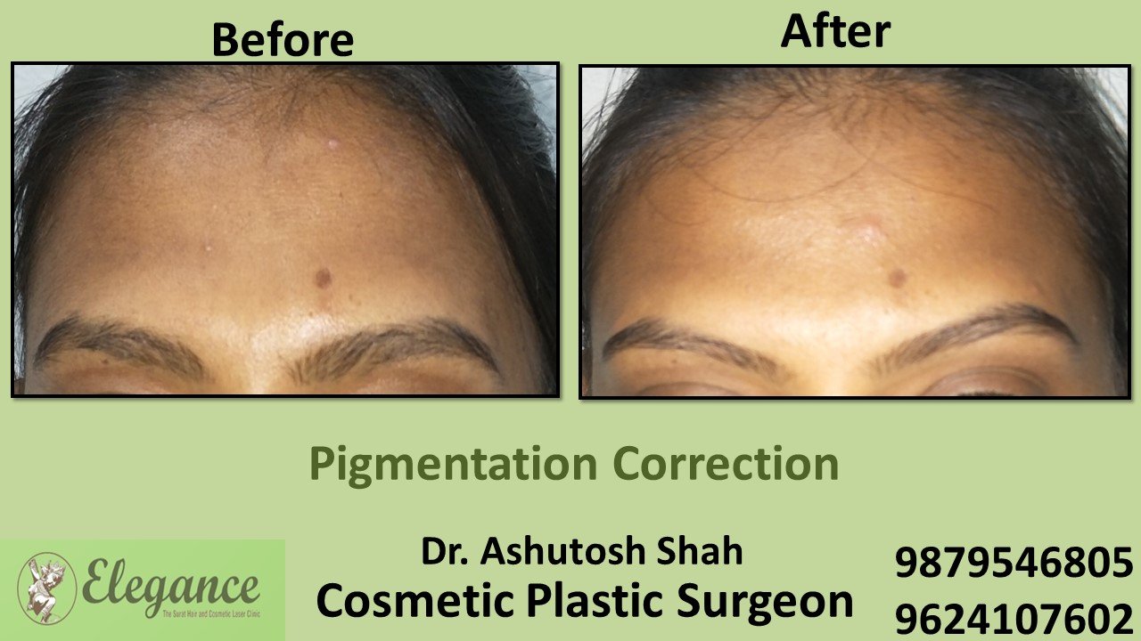 Pigmentation Treatment in Valsad, Gujarat, India.