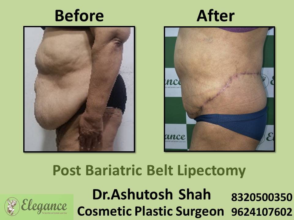 Post Bariatic Belt Lipectomy,Tummy Tuck Removing Surgery, Majura