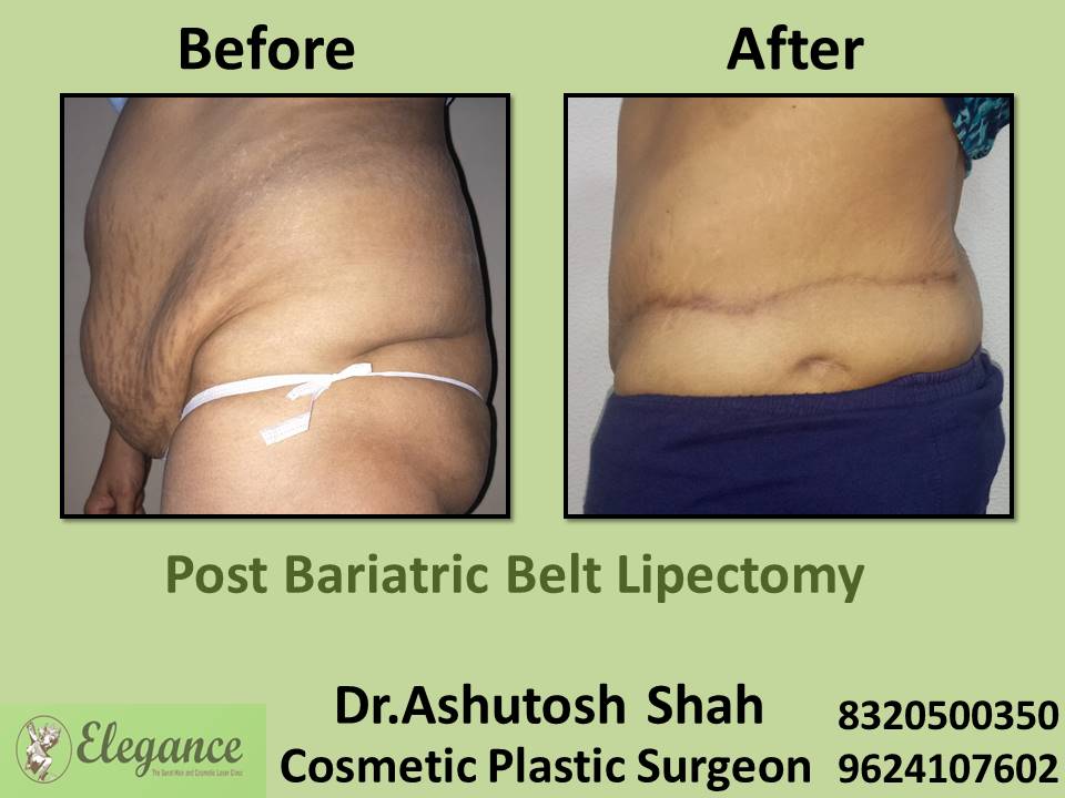 Tummy Tuck Removing Surgery, Post Bariatic Belt Lipectomy