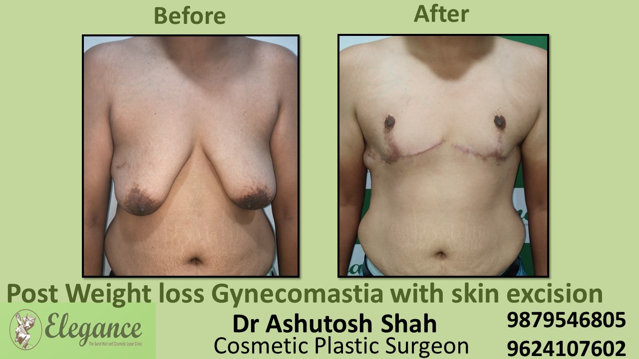 Post Weight Loss Gynecomastia Surgery in Navsari, Gujarat