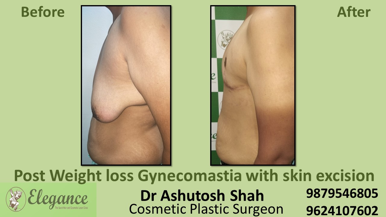 Post Weight Loss Gynecomastia Surgery in Surat, Gujarat