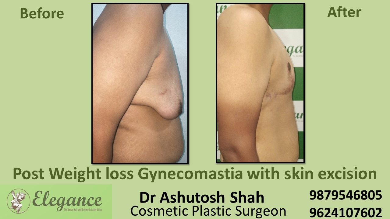 Post Weight Loss Gynecomastia Surgery in Valsad, Gujarat