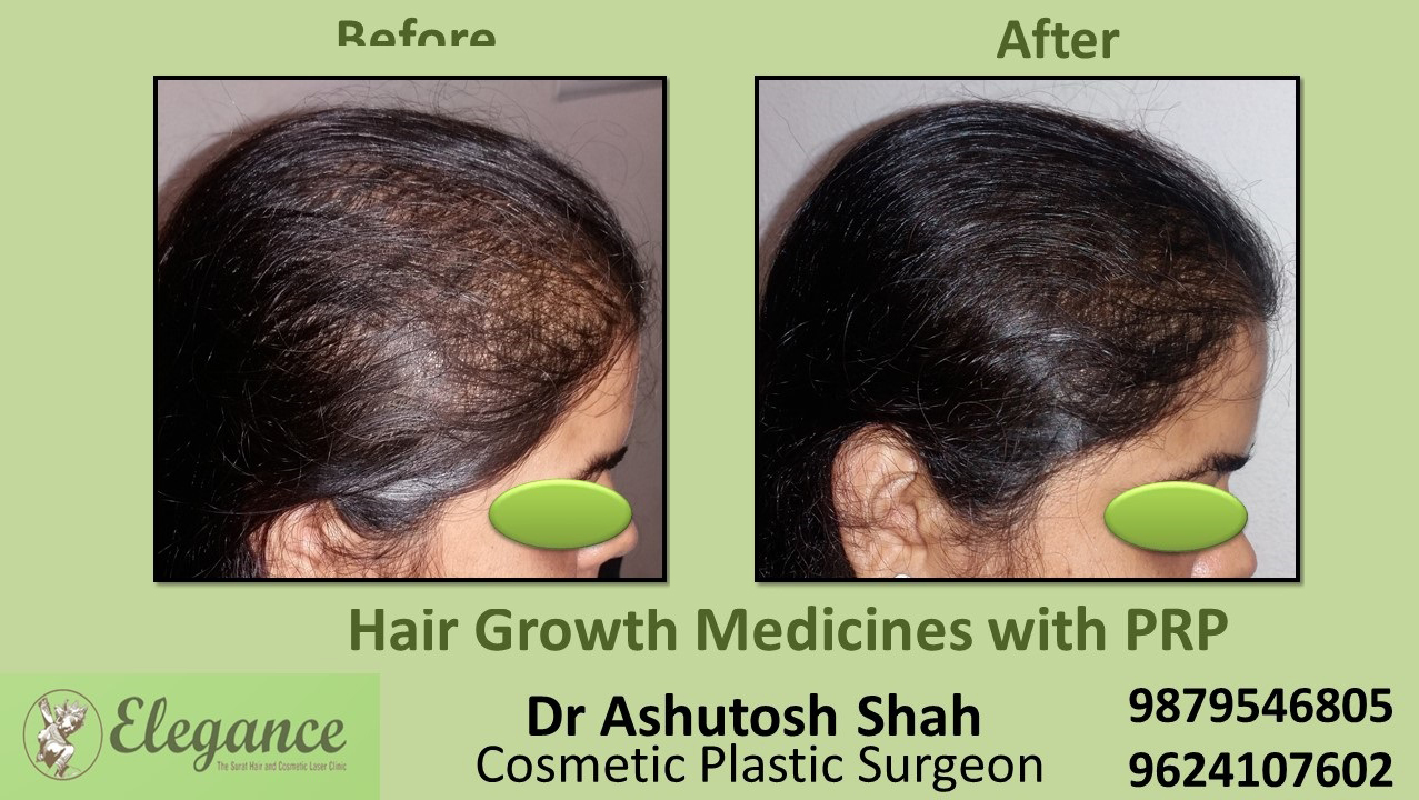 Hair Growth Medicines with PRP Mangrol, Gujarat