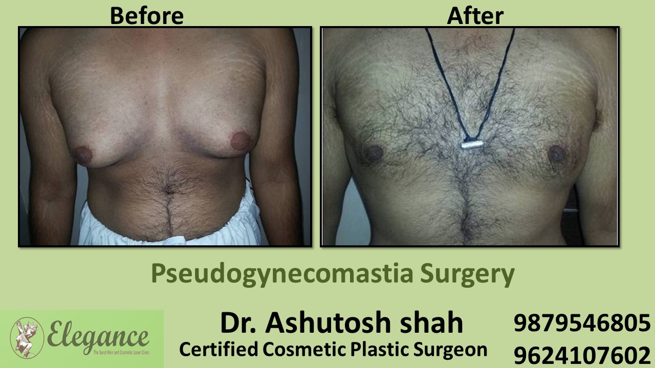 Pseudo Gynecomastia Surgery in Surat, Gujarat