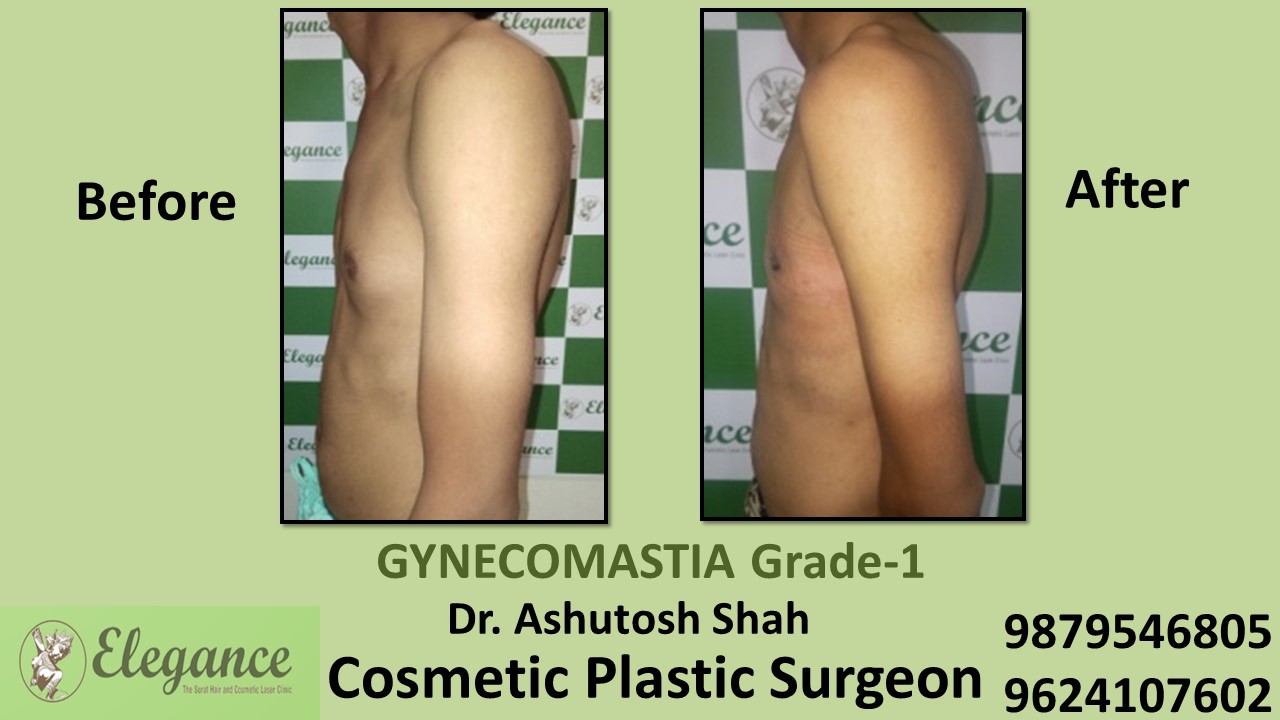 Puffy Nipples, Gynecomastia Grade-1 Surgery, Ankleshwar, Gujarat, India.