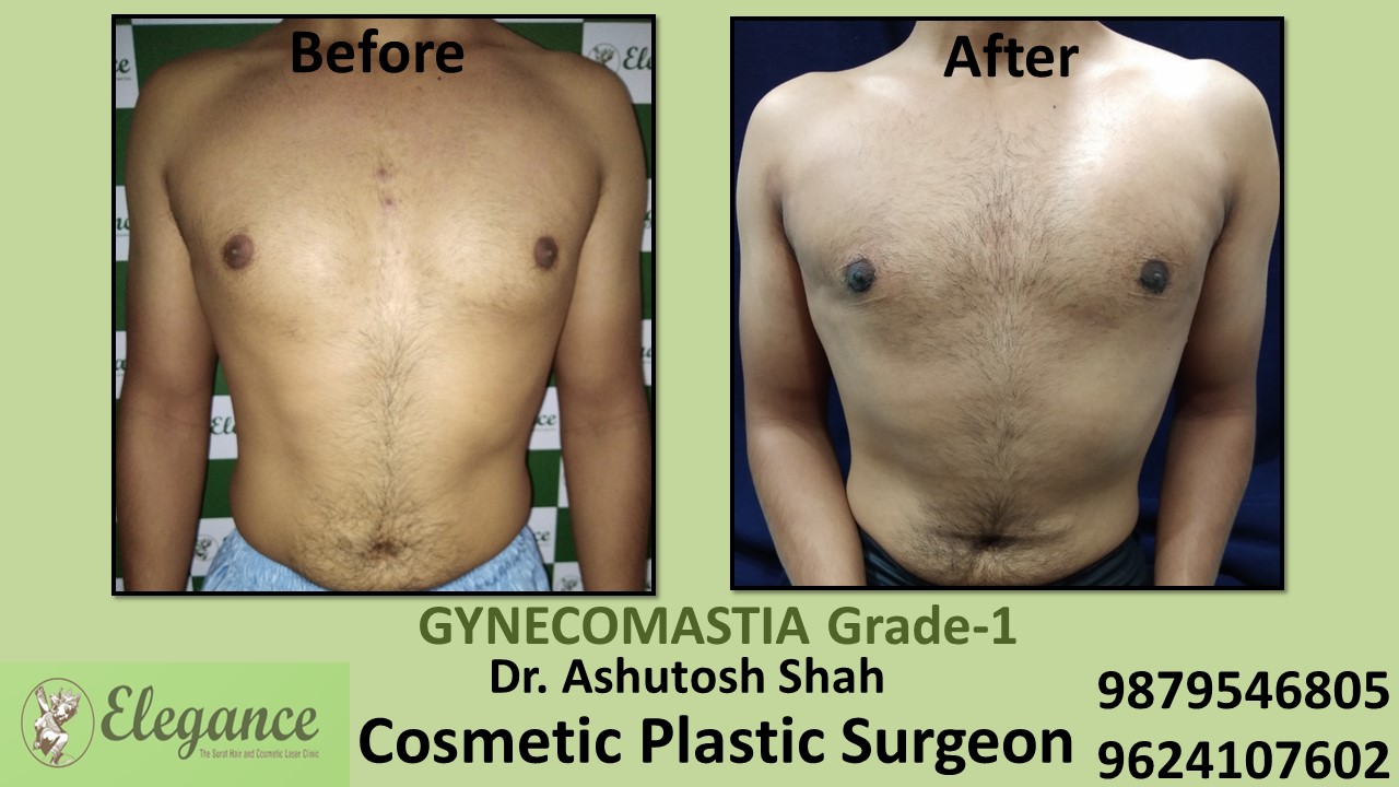 Puffy Nipples, Gynecomastia Grade-1 Surgery, Bardoli, Gujarat, India.