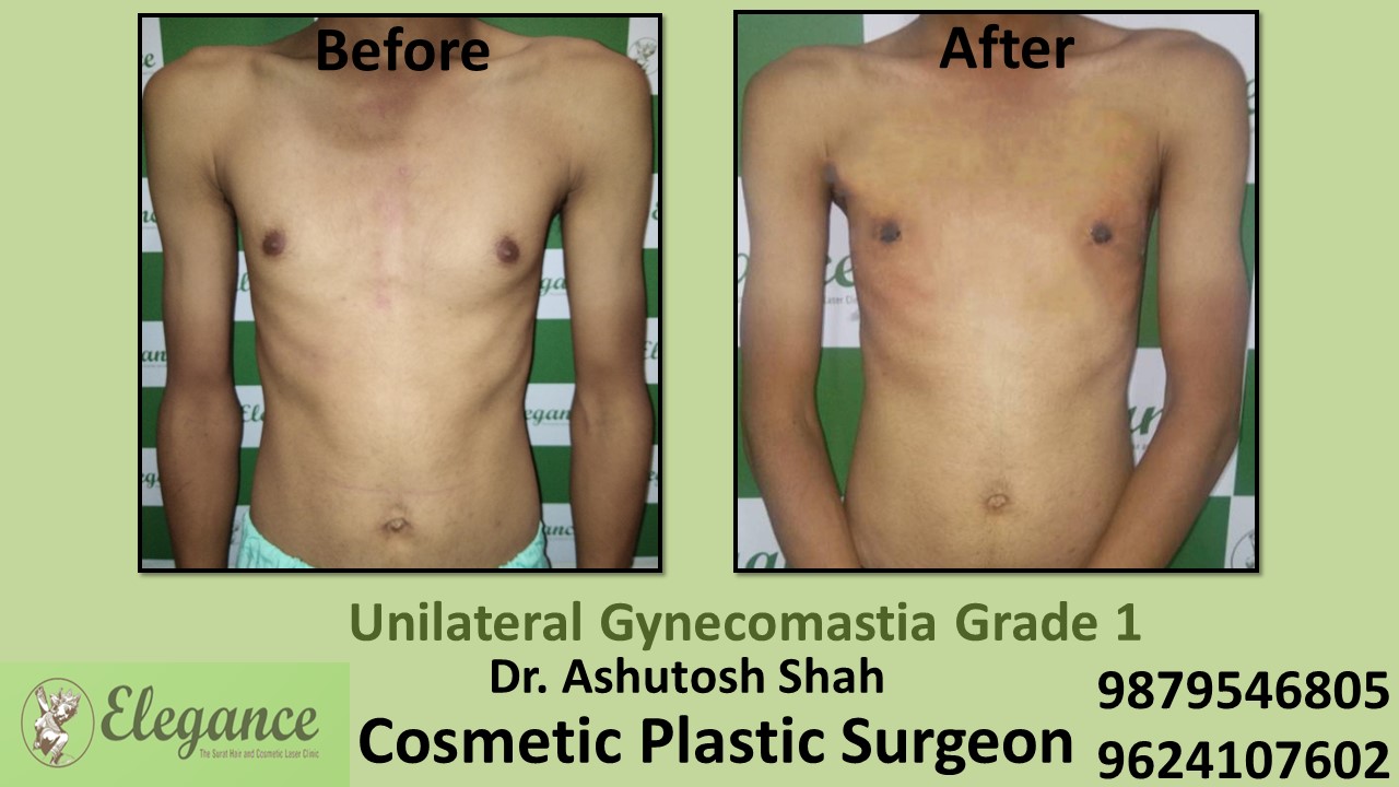 Puffy Nipples, Gynecomastia Grade-1 Surgery, Baroda, Gujarat, India.