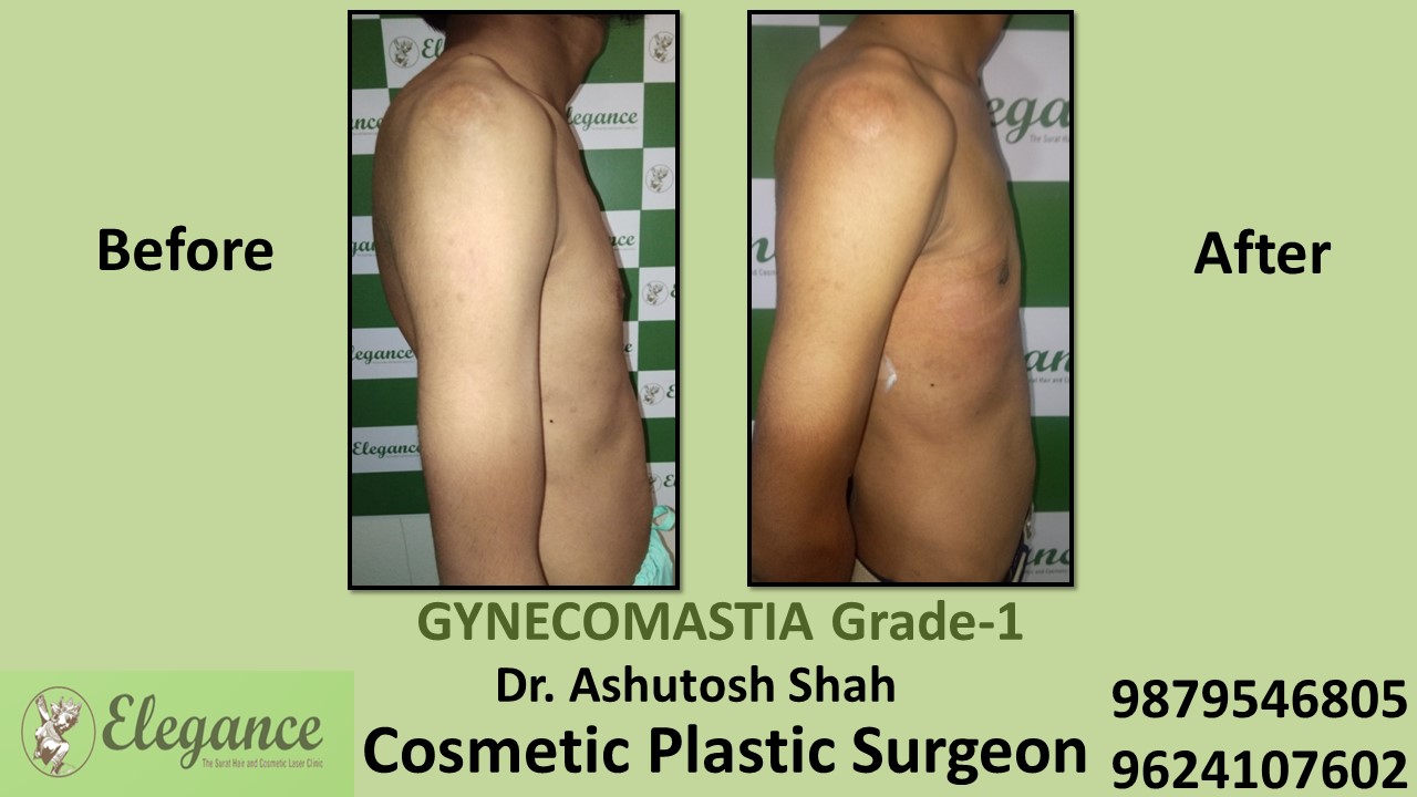 Puffy Nipples, Gynecomastia Grade-1 Surgery, Bharuch, Gujarat, India.
