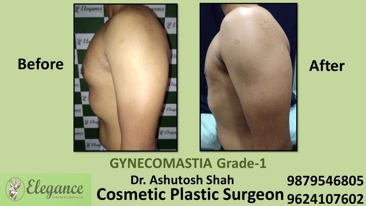 Puffy Nipples, Gynecomastia Grade-1 Surgery, Chhota Udaipur, Gujarat, India.