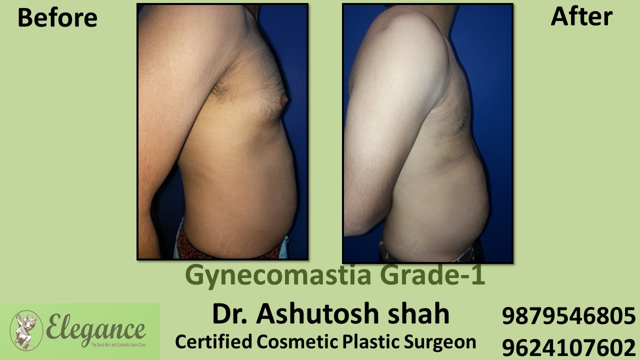Puffy Nipples, Gynecomastia Grade-1 Surgery, Daman, Gujarat, India.