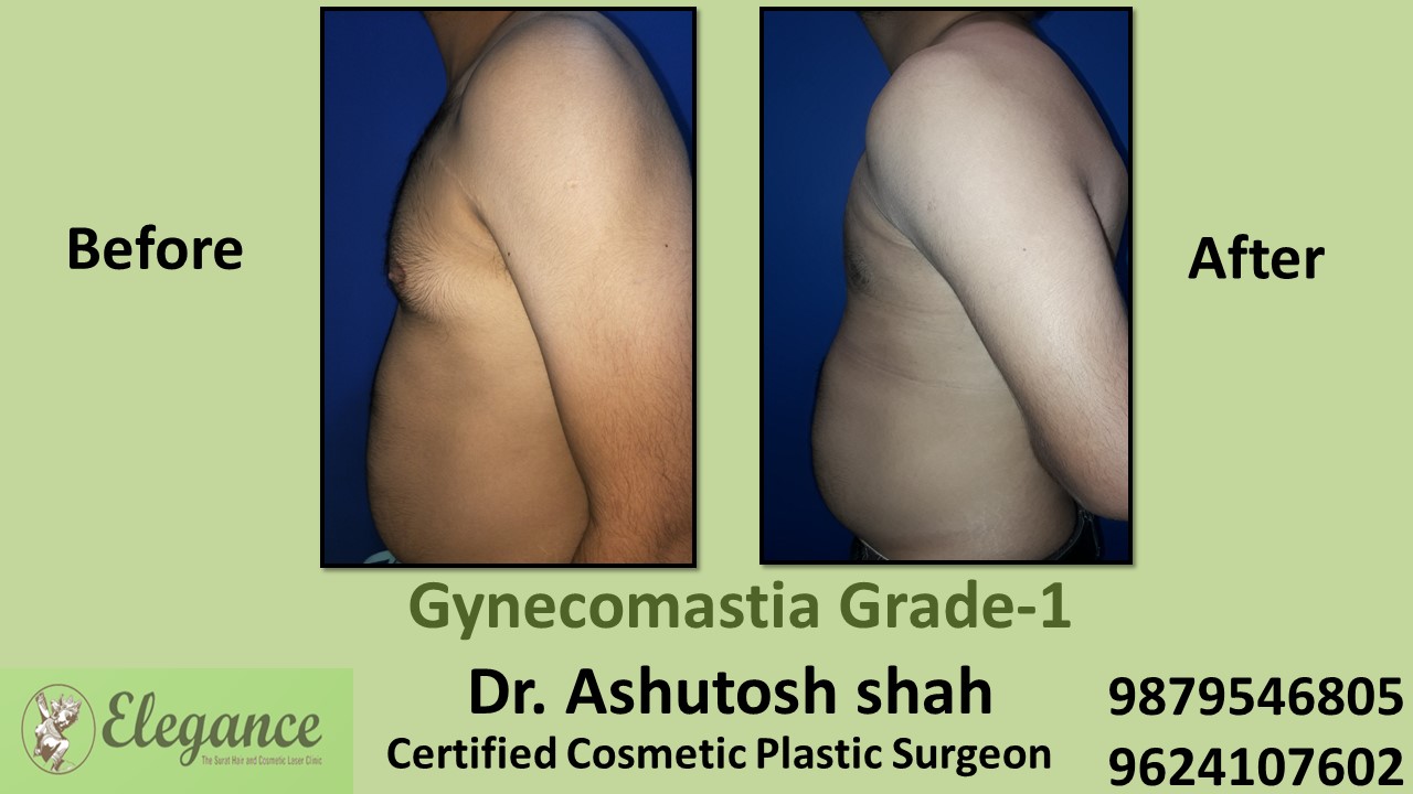 Puffy Nipples, Gynecomastia Grade-1 Surgery, Kosamba, Gujarat, India.