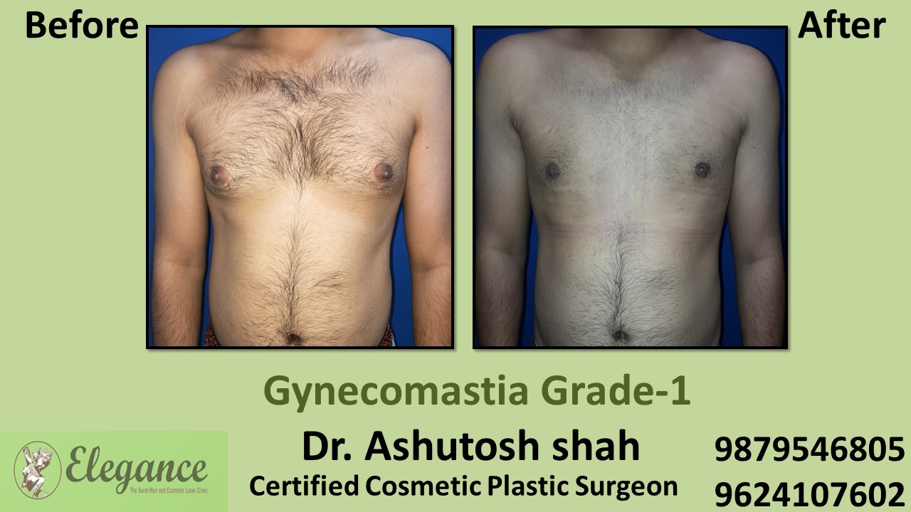 Puffy Nipples, Gynecomastia Grade-1 Surgery, Mangrol, Gujarat, India.