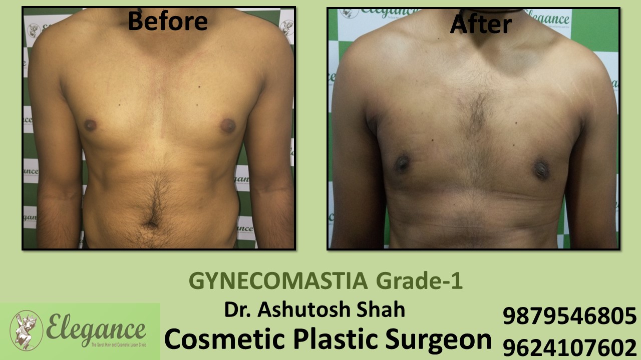 Puffy Nipples, Gynecomastia Grade-1 Surgery, Navsari, Gujarat, India.