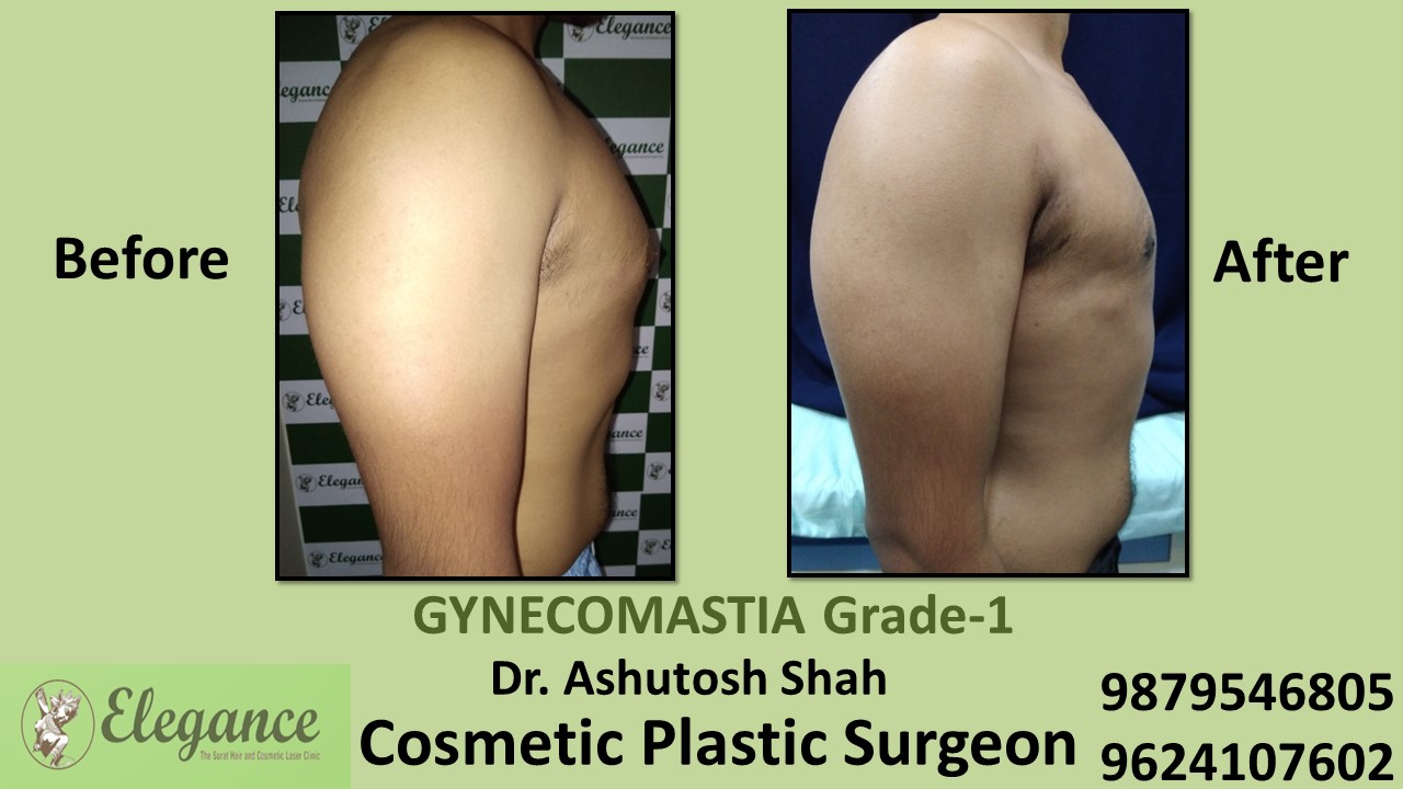 Puffy Nipples, Gynecomastia Grade-1 Surgery, Selvasa, Gujarat, India.