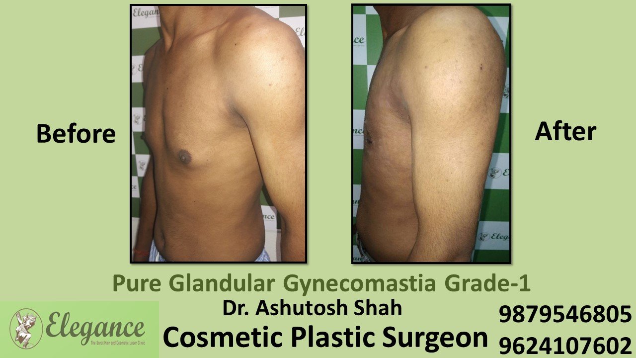 Puffy Nipples, Gynecomastia Grade-1 Surgery, Surat, Gujarat, India.