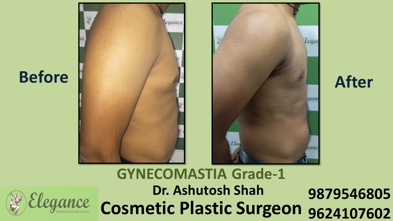 Puffy Nipples, Gynecomastia Grade-1 Surgery, Valsad, Gujarat, India.