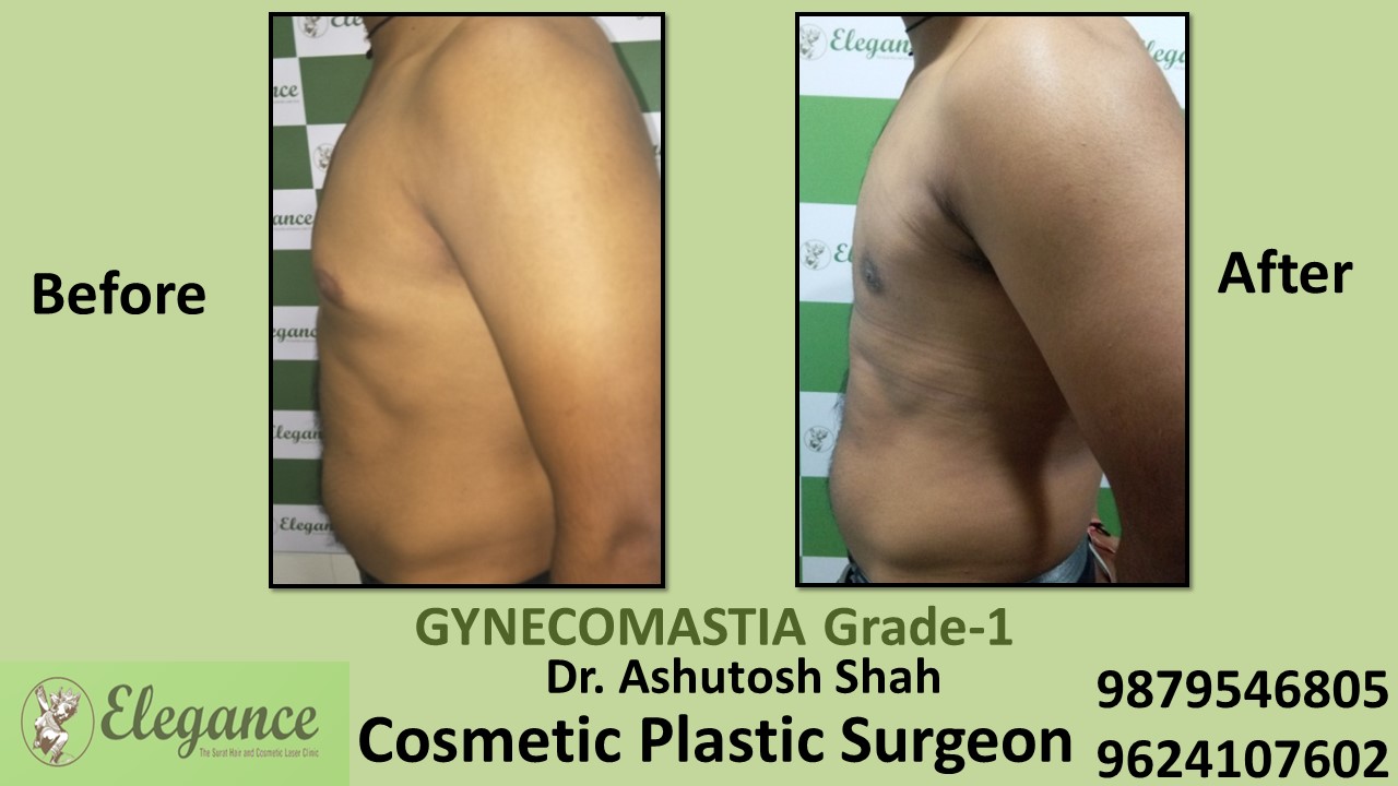 Puffy Nipples, Gynecomastia Grade-1 Surgery, Vapi, Gujarat, India.