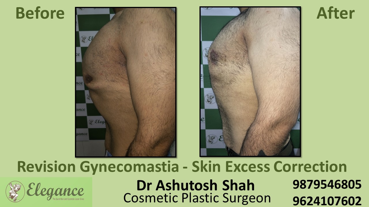 Revision Gynecomastia Cost in Ankleshwar, Gujarat
