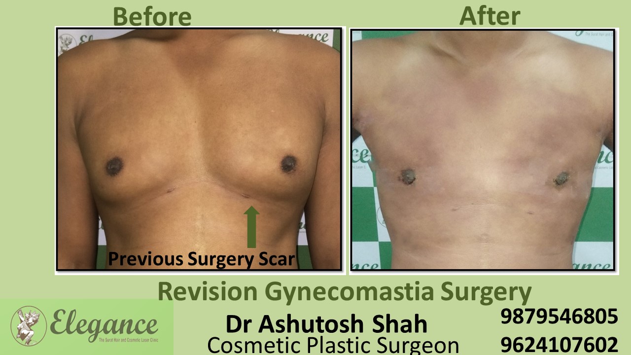 Revision Gynecomastia Cost in Surat, Gujarat.