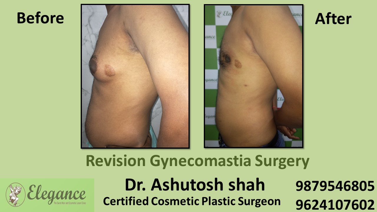 Revision Gynecomastia Surgery, Bilimora, Gujarat, India.