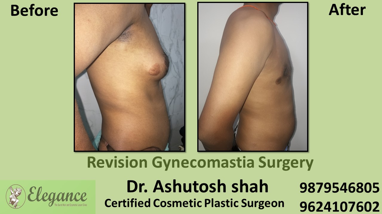 Revision Gynecomastia Surgery, Chhota Udaipur, Gujarat, India.