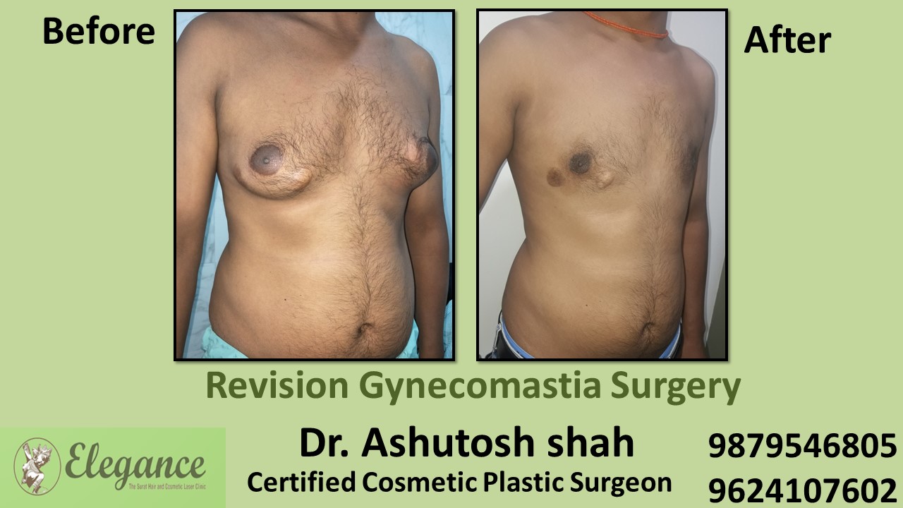Revision Gynecomastia Surgery, Chikhli, Gujarat, India