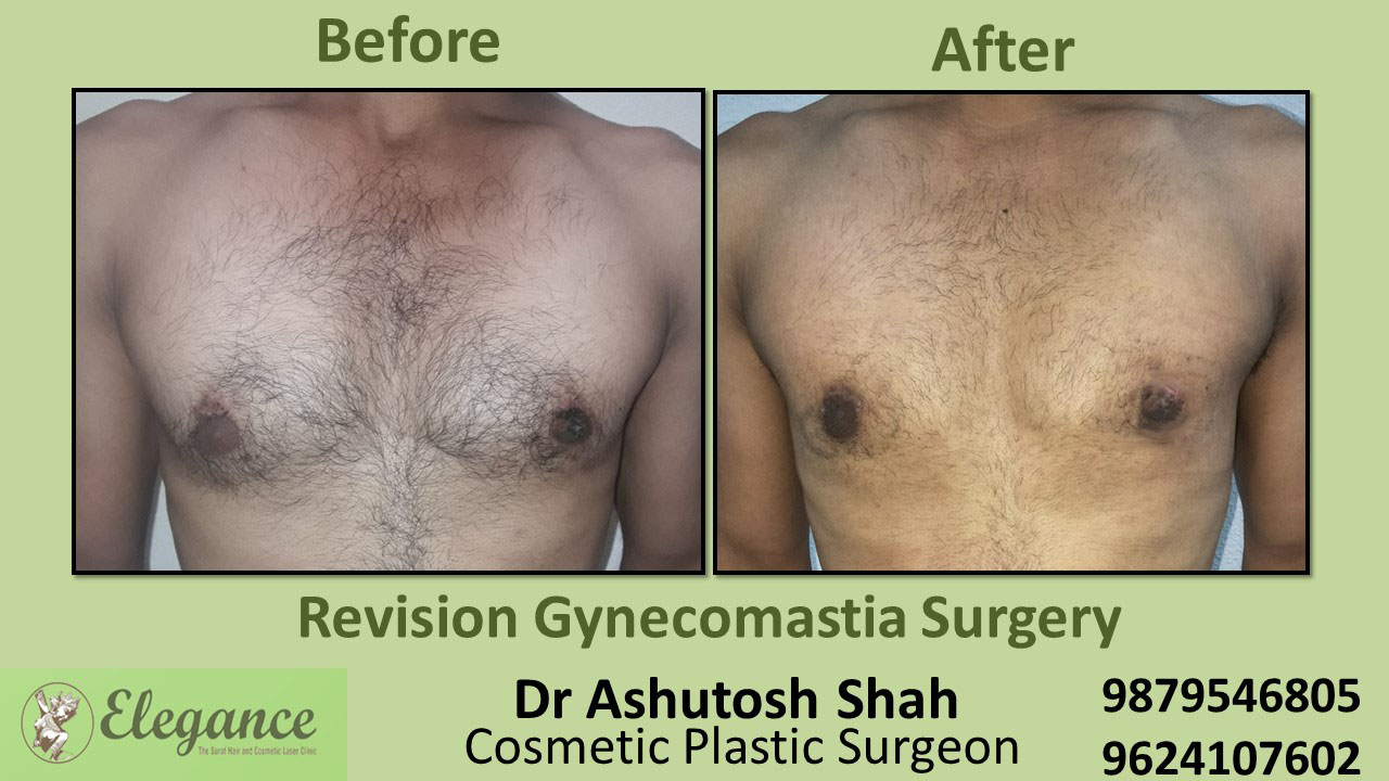 Revision Gynecomastia Surgery in Bharuch, Gujarat